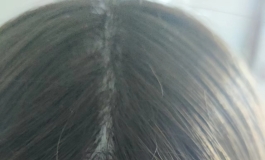 198植发？平民娃友的福利？米虫简评